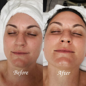 Before/After Classic Facial