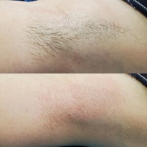 Before/After Underarm